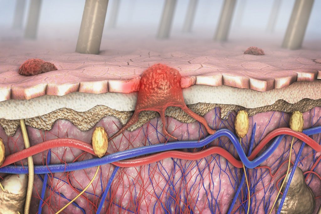 algoritmo para detectar melanoma