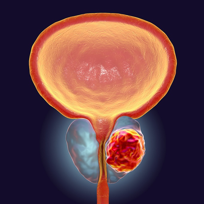 Cáncer de próstata: la segunda patología que más impacta a hombres en Colombia