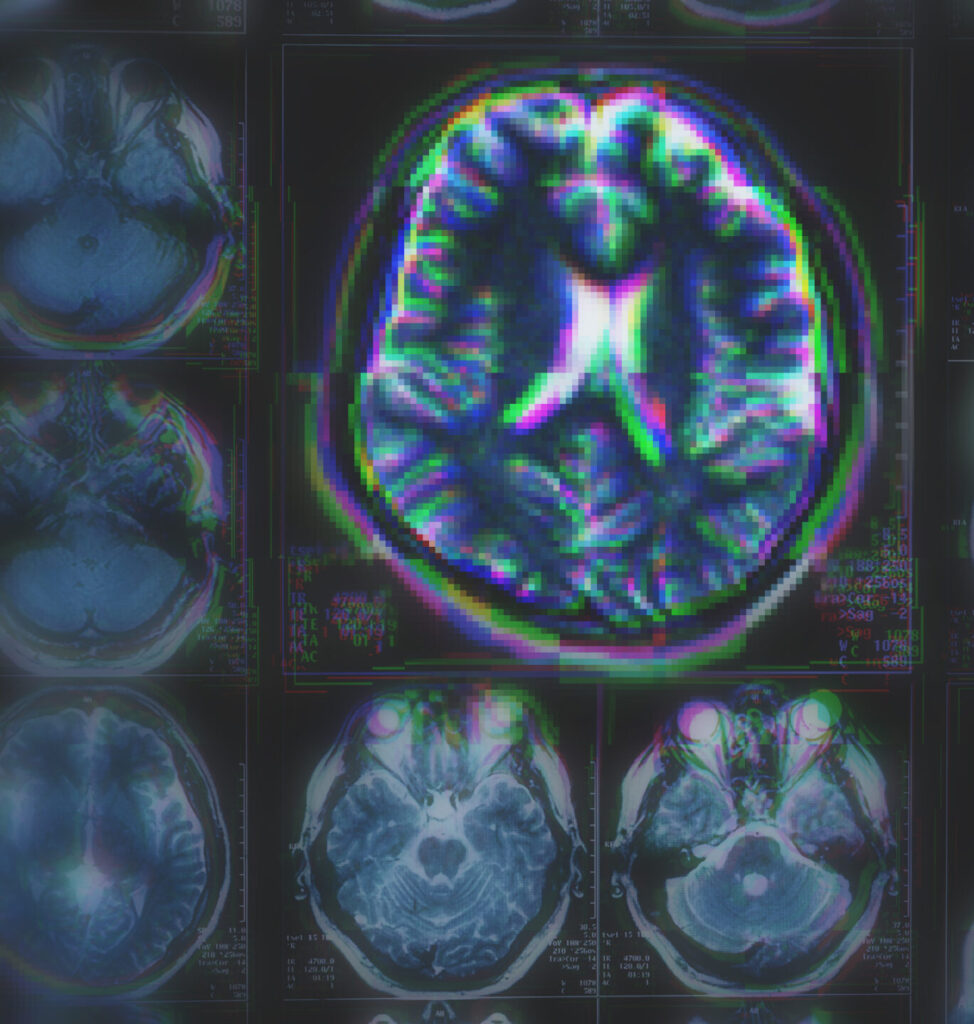 Medicamento que retrasa el Alzheimer