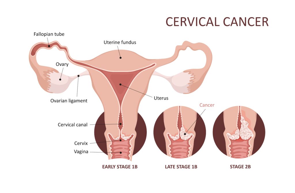 Importancia de la prevención del cáncer de cuello uterino