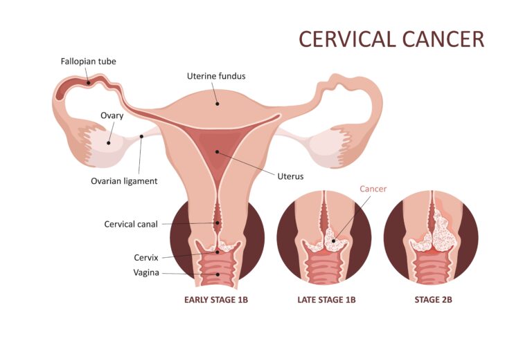 Importancia de la prevención del cáncer de cuello uterino