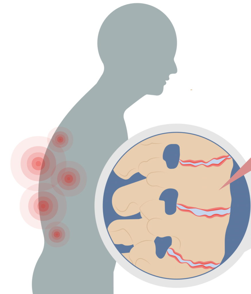 ¿Qué es la espondilitis anquilosante?