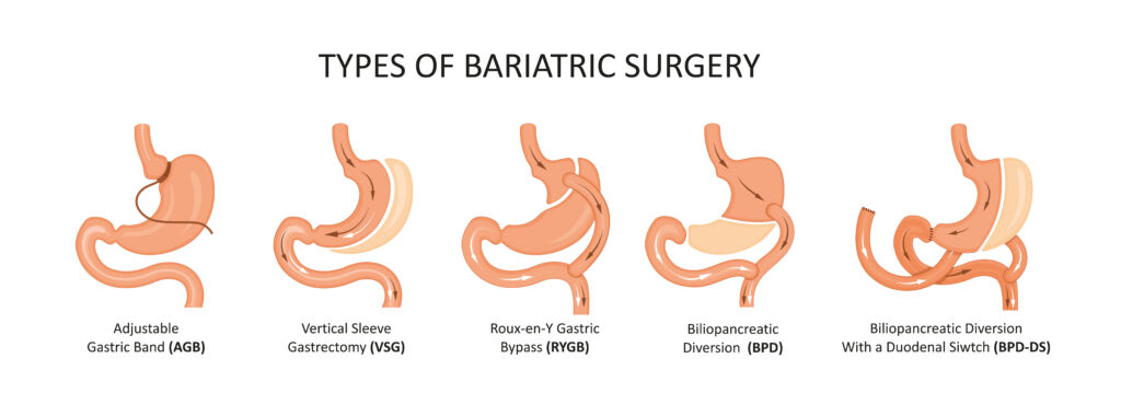 Cirugía bariátrica, una alternativa contra la obesidad